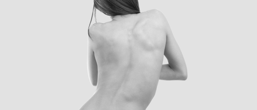 scoliosis girl